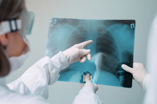 doctor reading a chest x-ray