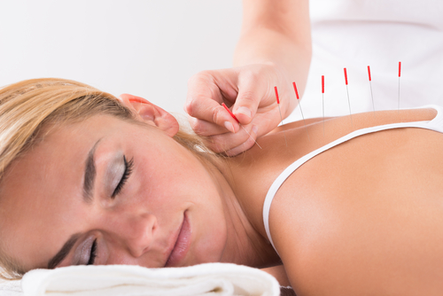 Does Acupuncture Work For Anxiety?