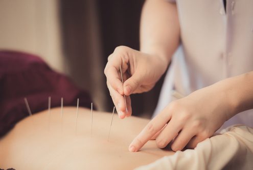 using acupuncture for back pain
