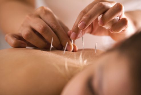 woman receiving acupuncture at home